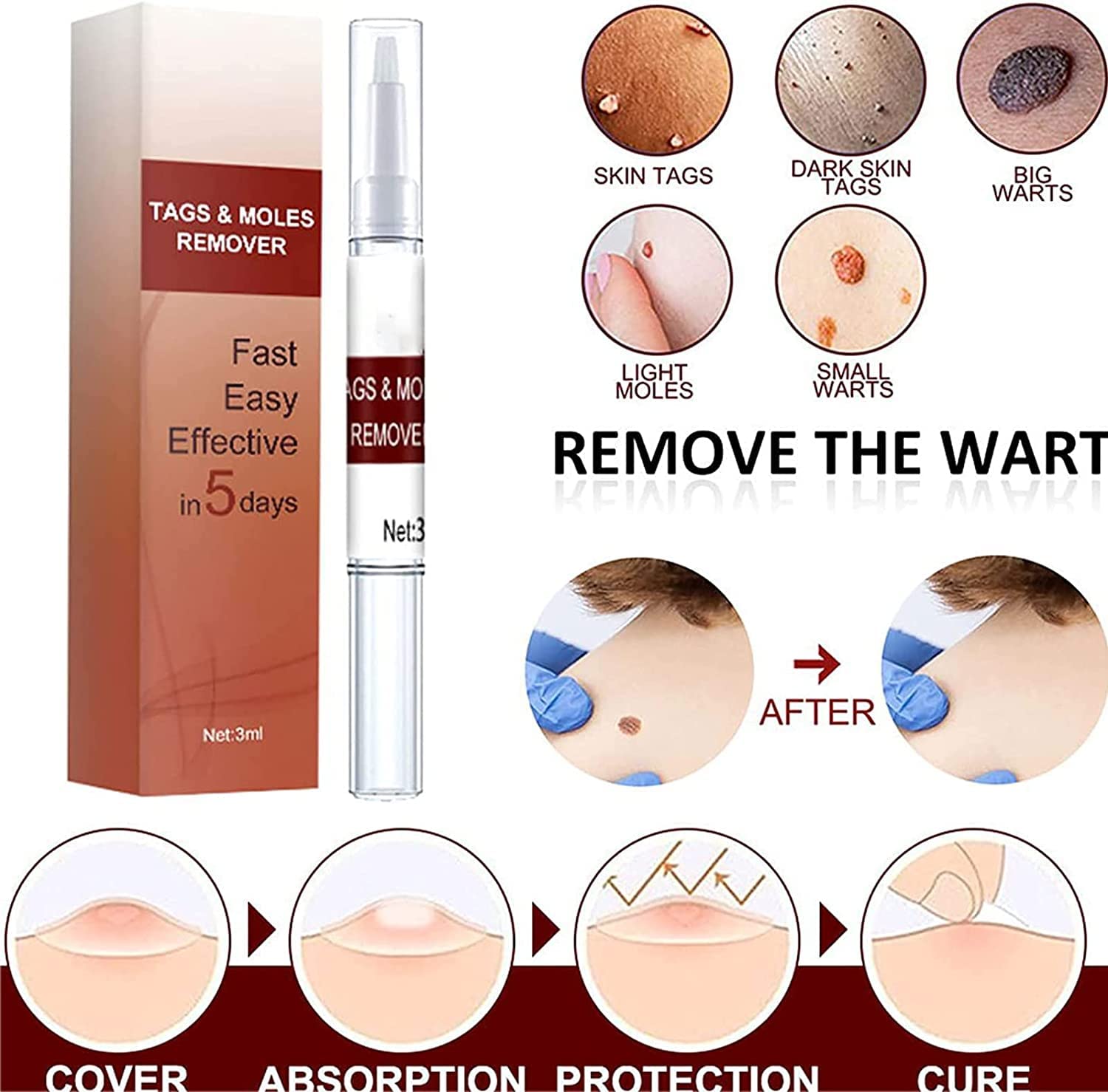 West Month Tags Moles Remover Pen Mole Remover Tags Remover Warts 3ml