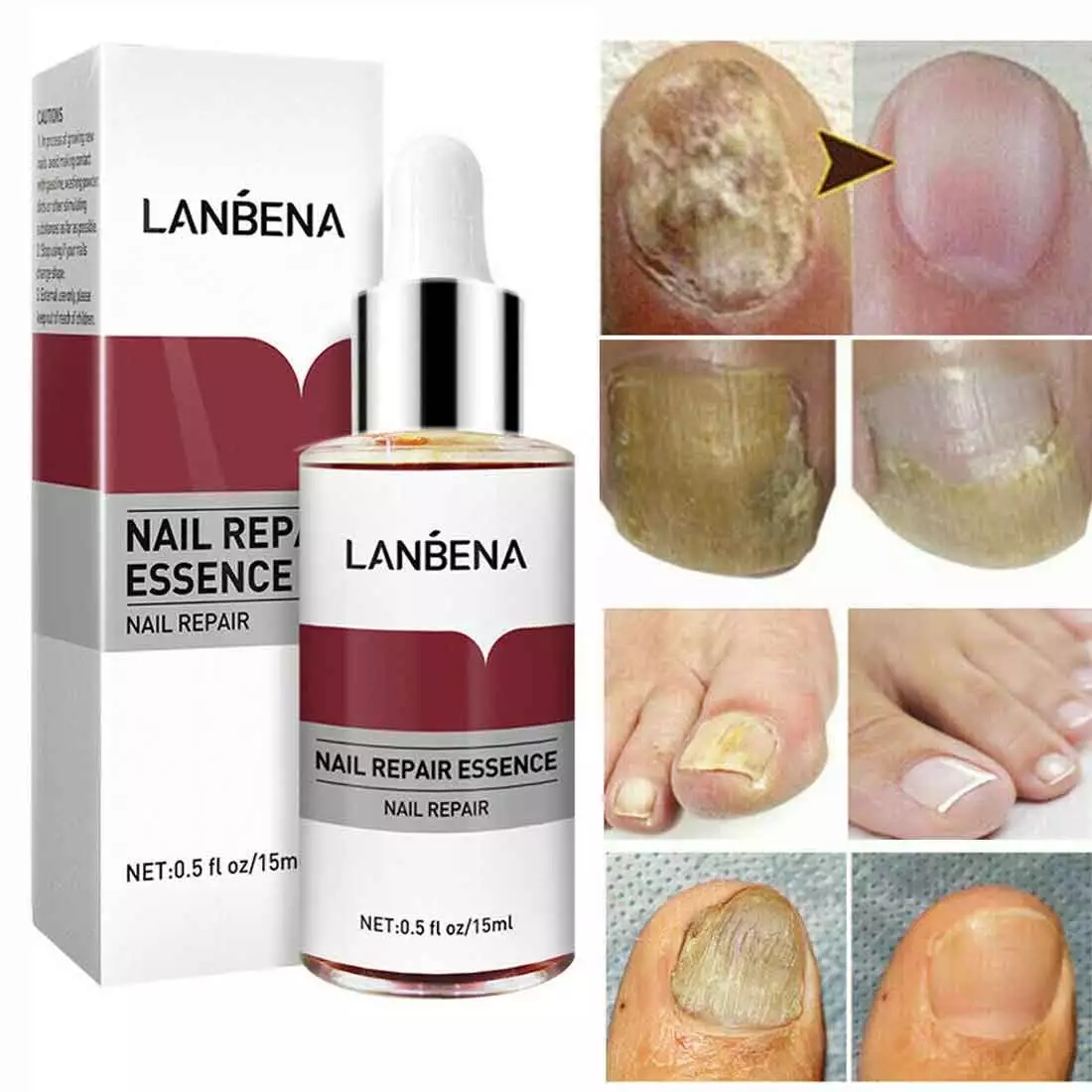 LANBENA Nail Repair Essence Serum Fungus Treatment Nail Removal Onychomycosis-15ml