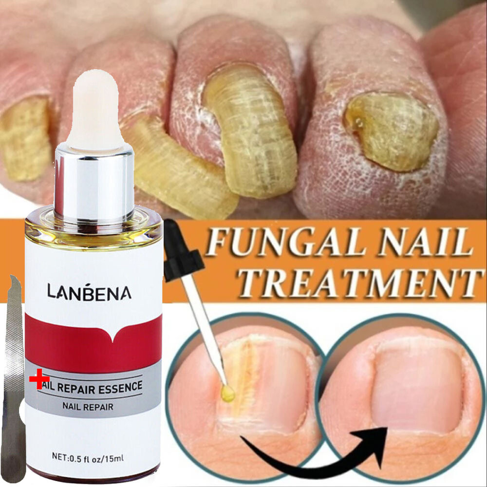 LANBENA Nail Repair Essence Serum Fungus Treatment Nail Removal Onychomycosis-15ml